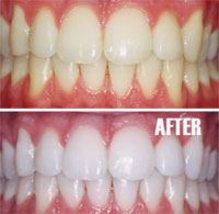 Get That Perfect Wedding Day Smile