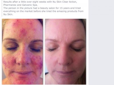 acne.jpg