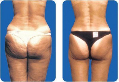cellulite.jpg